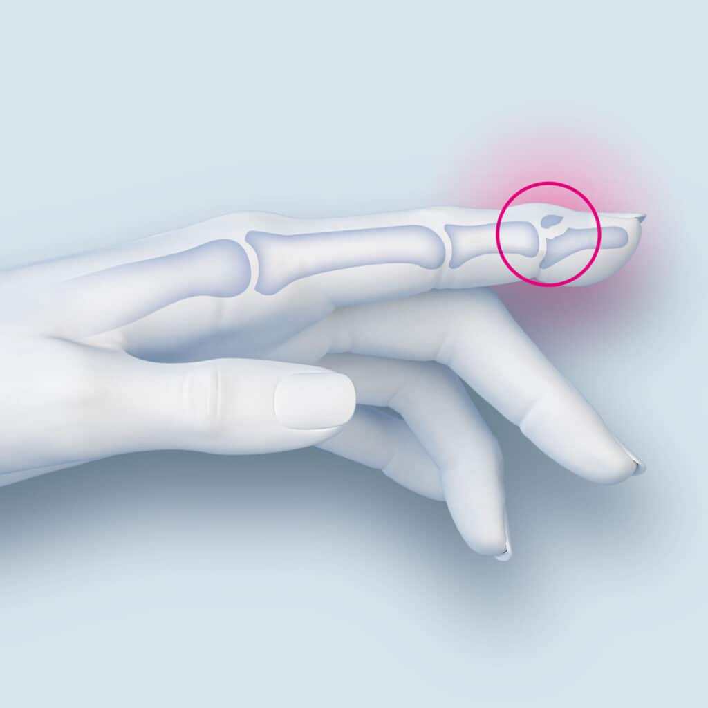 Fracture articulaire de la phalange distale avec subluxation de l'articulation interphalangienne distale