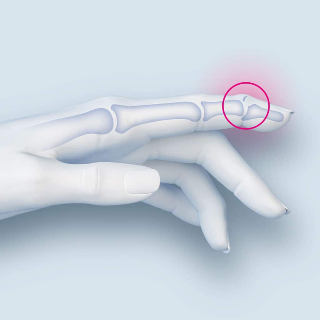 Arrachement osseux du tendon extenseur