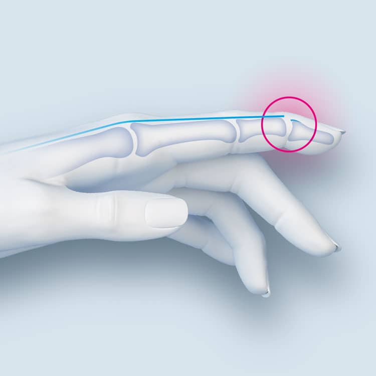 Rupture du tendon extenseur